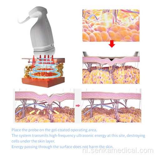 Draagbare Liposonix vaginale aanscherping machine